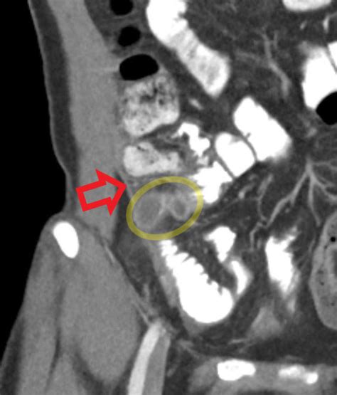 Peritoneal Abscess Appendix