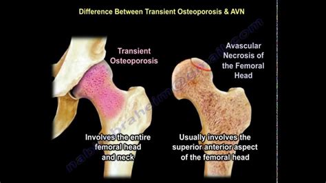 Transient Osteoporosis of the hip - Everything You Need To Know - Dr. Nabil Ebraheim - YouTube