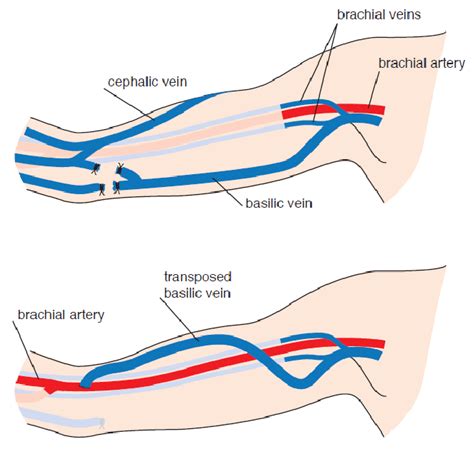 Autologous brachiobasilic arteriovenous fistula. A) The basilic vein is... | Download Scientific ...