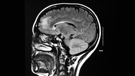 Normal And Abnormal Mri Brain Scans - vrogue.co