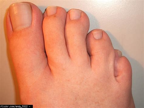 toenail melanoma picture - pictures, photos