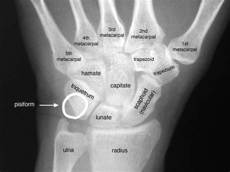 Scapholunate Ligament Tear