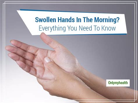 Wave Goodbye To Swollen Hands In The Morning By Learning Its Causes And Treatment | OnlyMyHealth