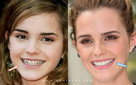 6 Shocking celebrity veneers with before & after pictures