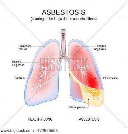 Asbestosis Lungs. Vector & Photo (Free Trial) | Bigstock