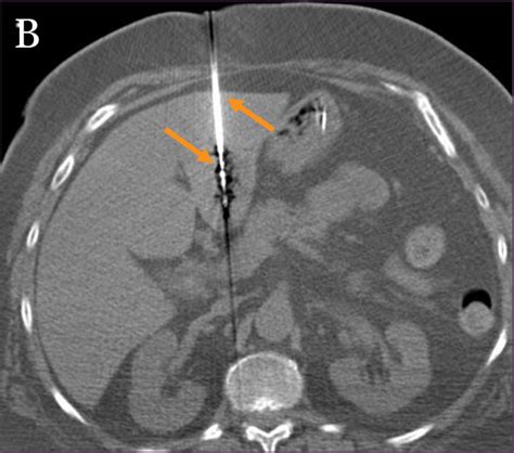 Figure A: Non-contrast CT demonstrating a 2.3 cm hypodense lesion in... | Download Scientific ...