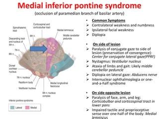 Medial Pontine Syndrome