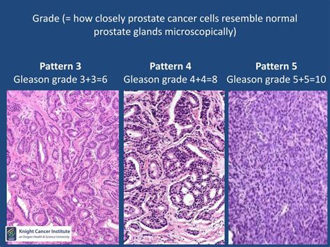 PPT - Prostate Cancer 101 Cell 616 PowerPoint Presentation, free ...