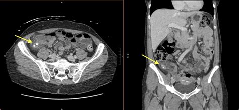 Abdominal Imaging Call Prep Cases: Acute Uncomplicated Appendicitis (CT) - Stepwards