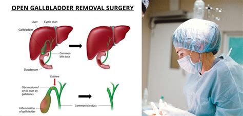 Open Cholecystectomy - Procedure, Purpose, Side Effects