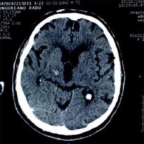 (PDF) Hemiballismus after hemorrhagic stroke