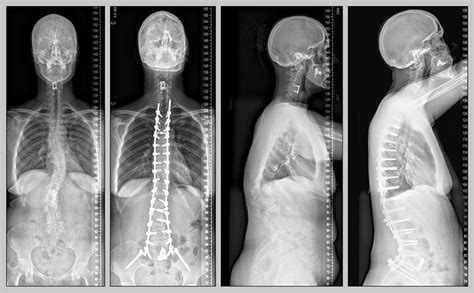 Severe spinal deformity correction - Mayo Clinic