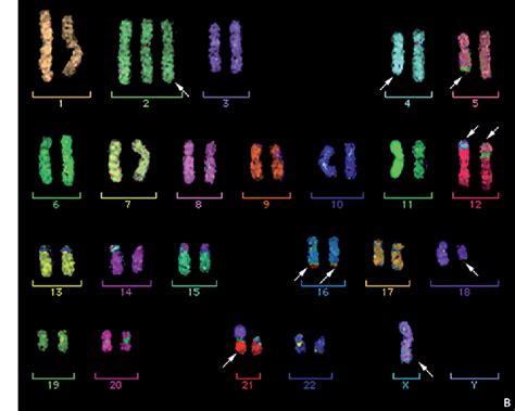 Figure 4 from Multiplex-FISH (M-FISH): technique, developments and ...