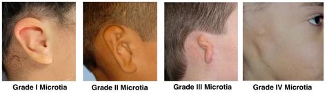 Microtia Infant Ear Deformity - EarWell® Infant Ear Correction System