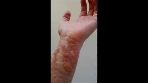 ouch BOILING OIL BURN & AWWW HONEY TREATMENT #1 - YouTube