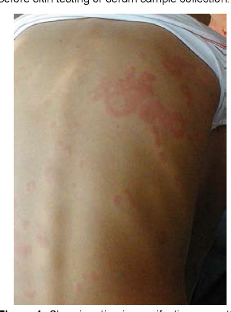 Chronic autoimmune urticaria in children. | Semantic Scholar