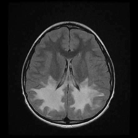 Metachromatic Leukodystrophy Children