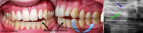 Idiopathic condylar resorption - Dr Sylvain Chamberland Orthodontiste