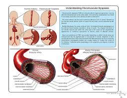 Fibromuscular dysplasia