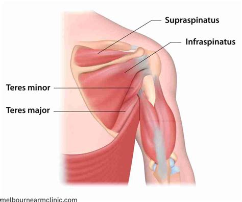 Supraspinatus Tear Causes & Treatment - Melbourne Arm Clinic