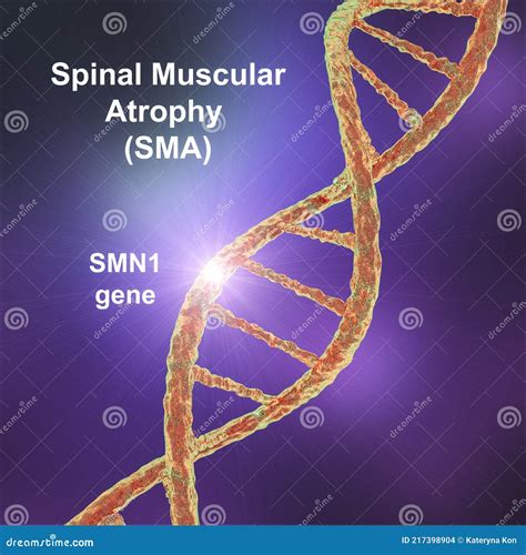 Spinal Muscular Atrophy, SMA, a Genetic Neuromuscular Disorder Stock Illustration - Illustration ...