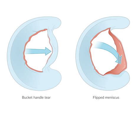 Bucket-handle Tear Of The Meniscus Radsource, 46% OFF