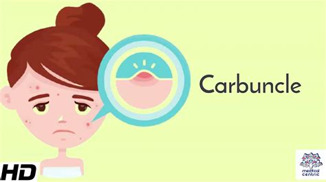 Carbuncle, Causes, Signs and Symptoms, Diagnosis and Treatment. - YouTube