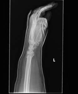 When Does The Cast Come Off? - Broken Arm Answers | Symptoms Treatment in Children | Resources ...