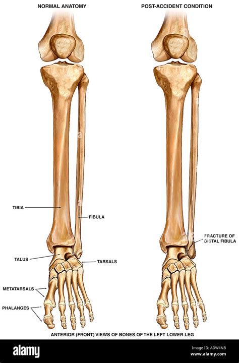 Lateral malleolus fracture hi-res stock photography and images - Alamy