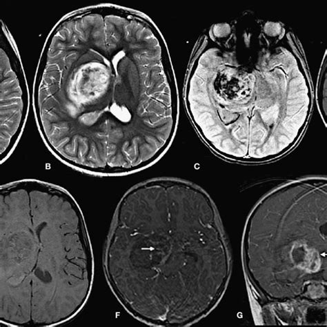 (PDF) Juvenile Pilocytic Astrocytoma in Association with Arteriovenous ...