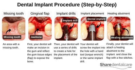 Dental Implant Procedure: A Step-by-Step Guide - Share Dental Care