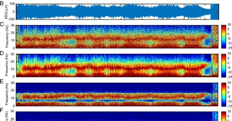 EEG monitoring of anesthesia | Picower Institute