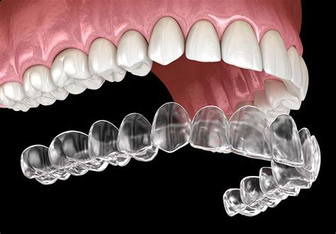 How does Invisalign treatment work? - Coastal Dental