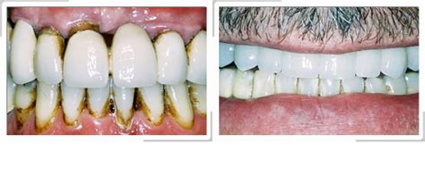 Cas cliniques - Sourire Avant / Après - Dr DAVID - Dentiste Thiais