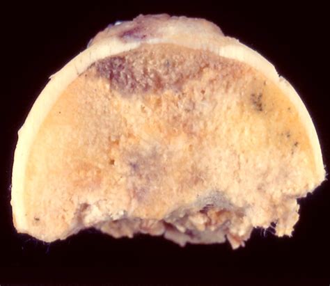 Pathology Outlines - Aseptic bone necrosis