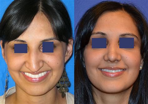 Cosmetic Rhinoplasty - Ethnic Rhinoplasty - Septoplasty