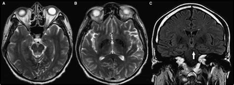 Typical MRI findings in Wernicke encephalopathy-Axial T2-weighted ...