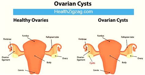 Treatment of a ruptured ovarian cyst - HealthZigZag