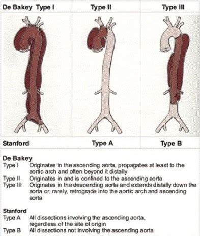 Aortic Dissection - Newport Cardiac & Thoracic Surgery