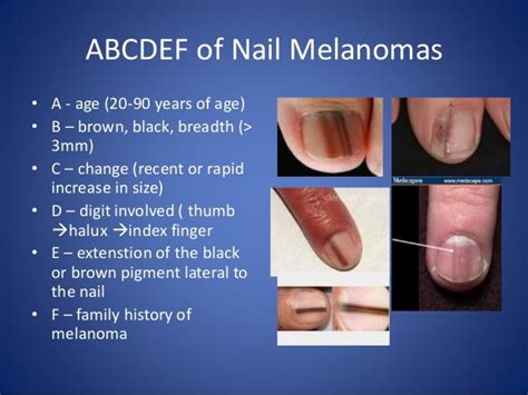 Big Toenail Has Vertical Light Brown Line: Melanoma? — Scary Symptoms