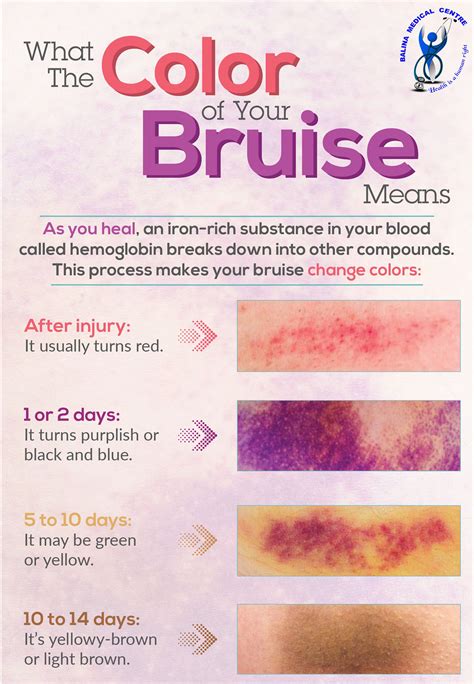 As a bruise heals, hemoglobin... - Balina Medical Centre | Facebook