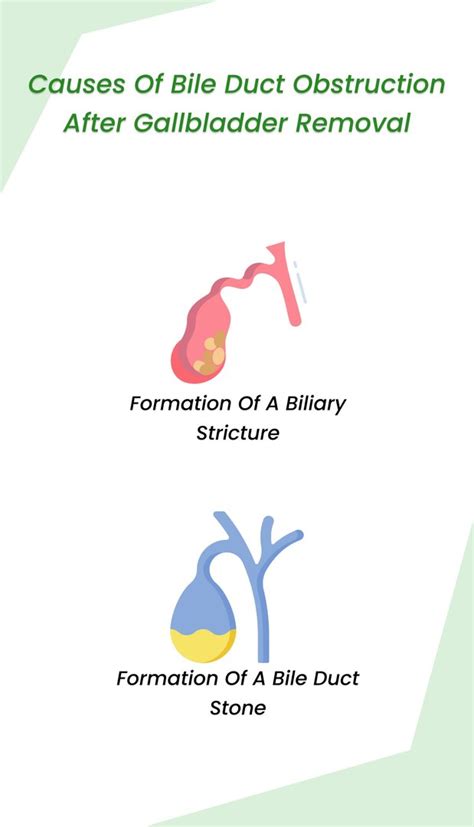 Bile Duct Obstruction after Gallbladder Removal | ClinicSpots