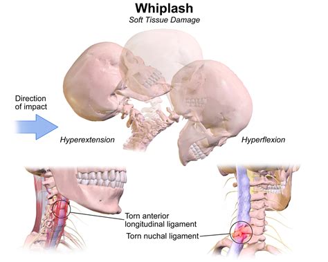 Whiplash Injury On Nerves