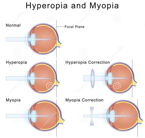 Myopia & Hyperopia | Vision Care(I) Pvt Ltd