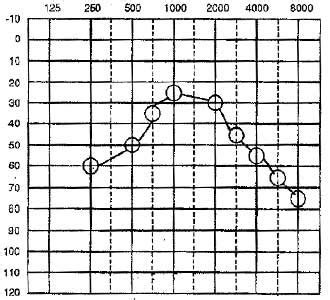 Pure Tone Audiogram: Symbols | Configuration | Interpretation