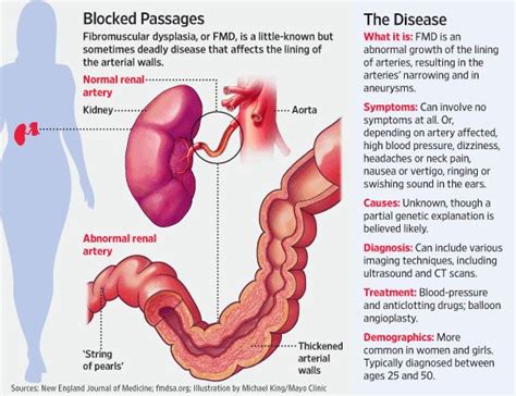 25 best images about Fibromuscular Dysplasia on Pinterest | Stains, The two and Case study