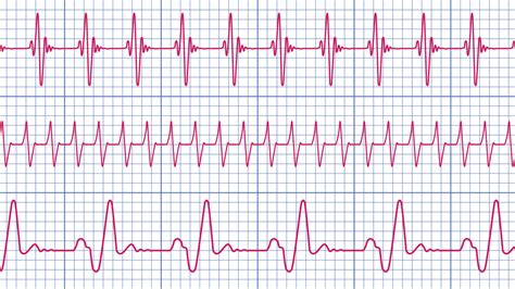 When Your Heart Skips A Beat - UW Medicine Provider Resource