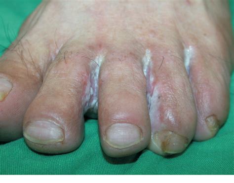 Figure 1 from Foot bacterial intertrigo mimicking interdigital tinea pedis. | Semantic Scholar