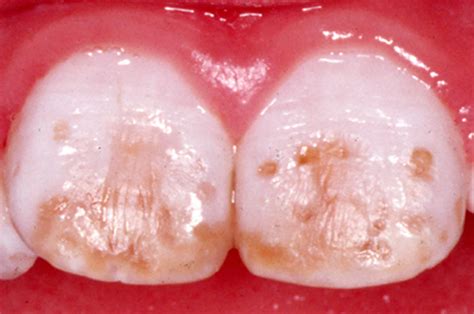 Dental fluorosis causes, prevention, symptoms & dental fluorosis treatment