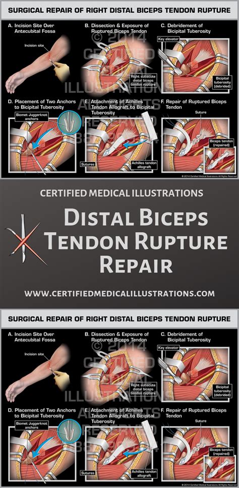 Distal biceps tendon rupture is a fairly rare injury that is most commonly seen in men between ...